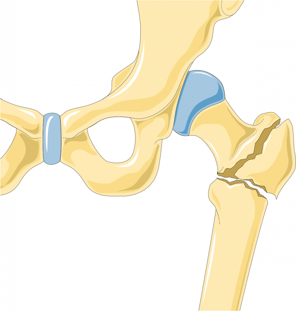 frattura ossea trattata con magnetoterapia