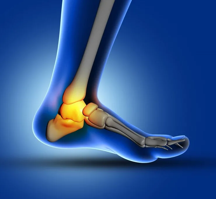 Edema osseo astragalo: Diagnosi e trattamento